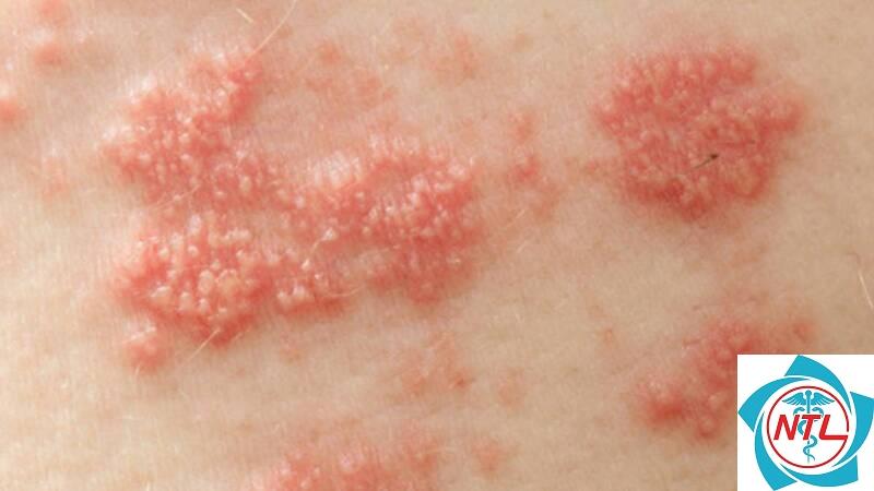 bệnh da do HPV - Image 2