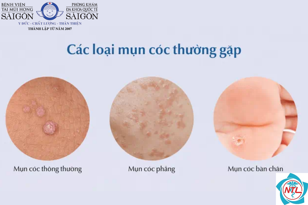 bệnh da do HPV - Image 3