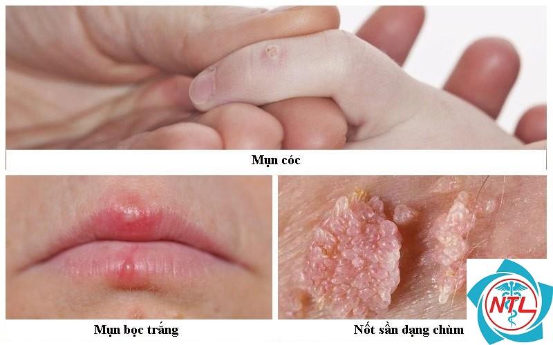 bệnh da do HPV