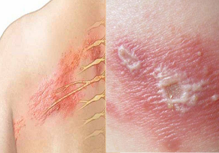 bệnh da do virus