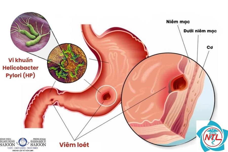 bệnh da loét mạn tính