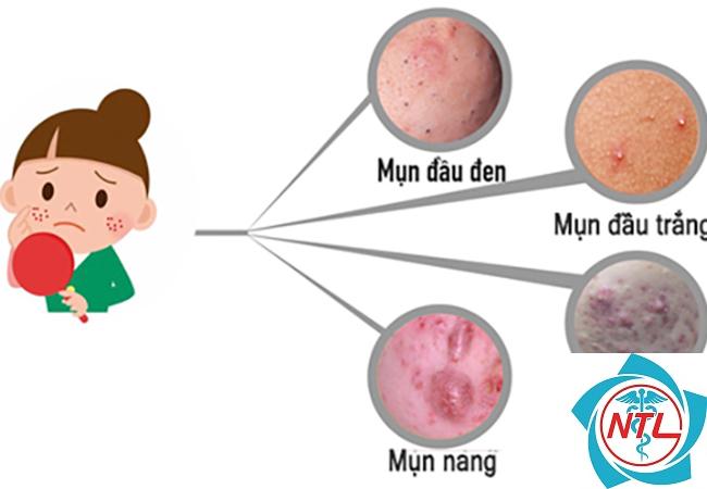bệnh da ở tuổi dậy thì - Image 3