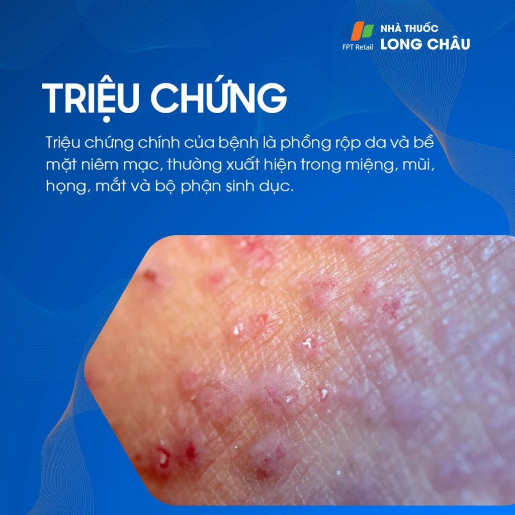 bệnh da phồng rộp tự miễn