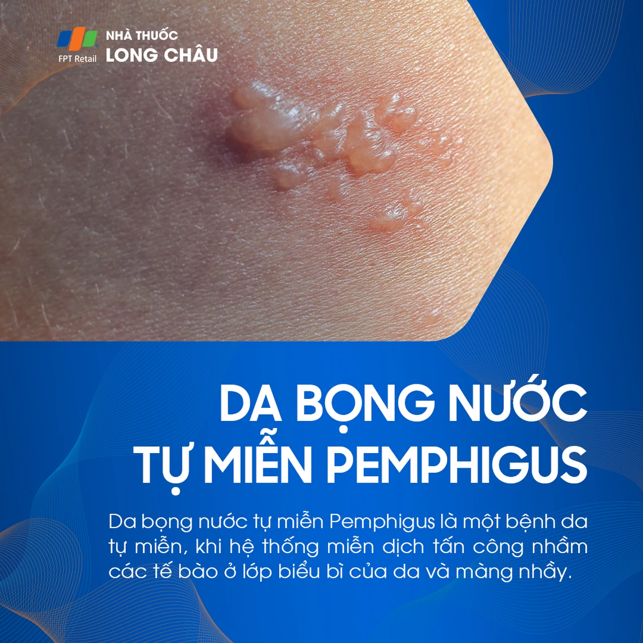 bệnh da phồng rộp tự miễn - Image 3