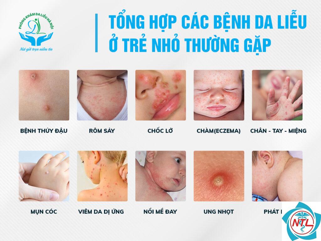 bệnh da thường gặp ở trẻ em