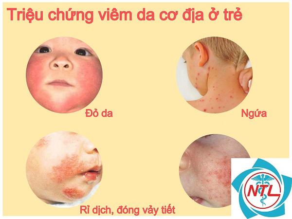 bệnh da thường gặp ở trẻ sơ sinh - Image 3