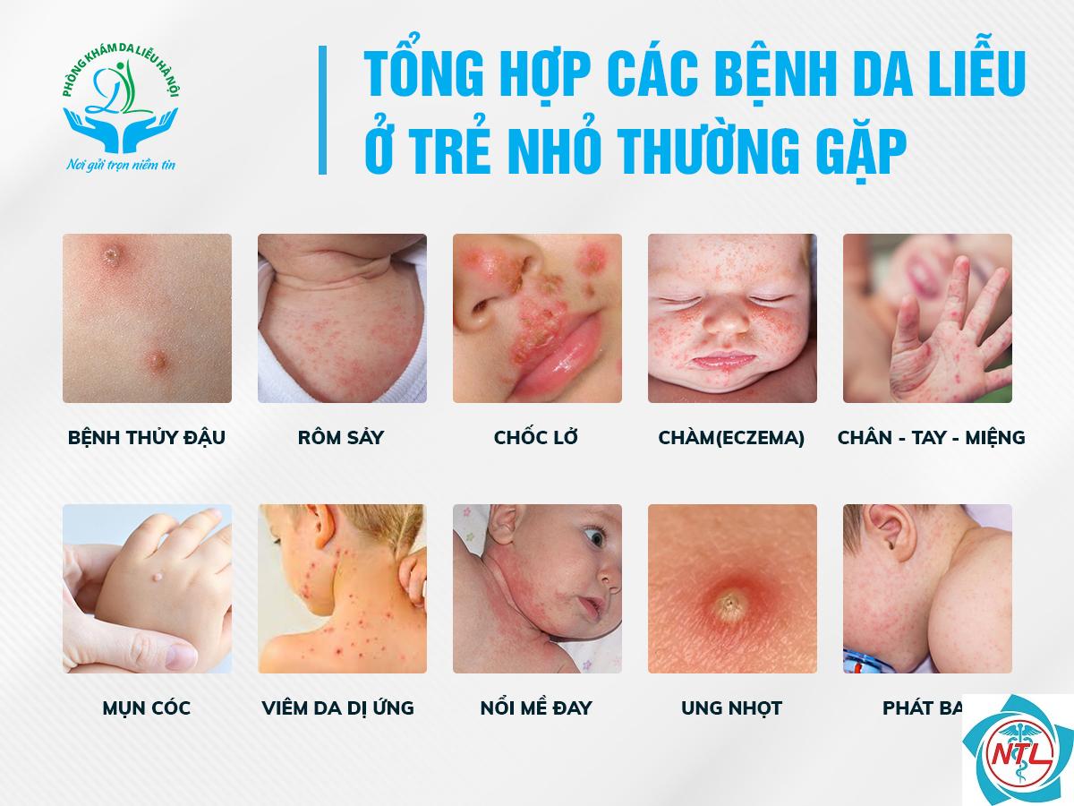 bệnh da thường gặp ở trẻ sơ sinh - Image 1