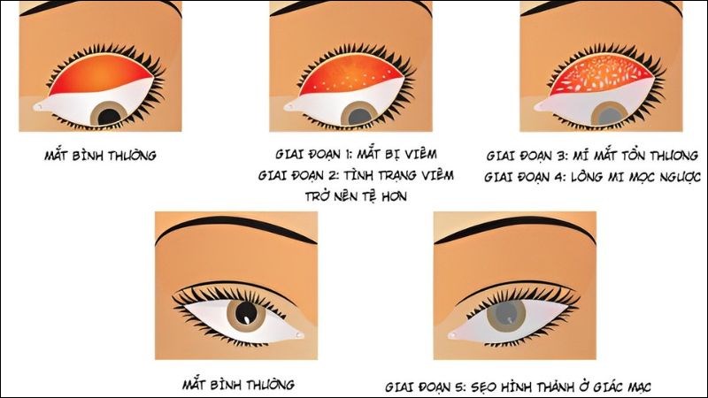bệnh đau mắt hột và cách điều trị - Image 2