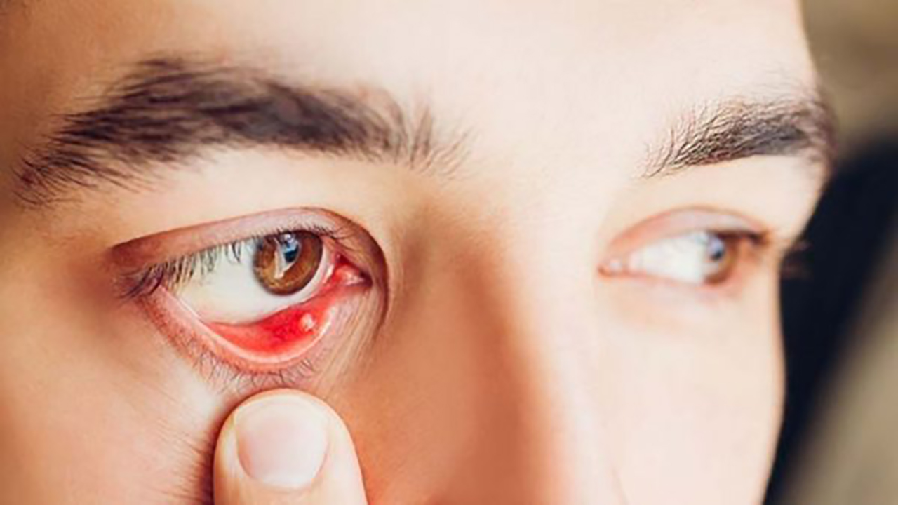 bệnh đau mắt hột và cách điều trị - Image 3