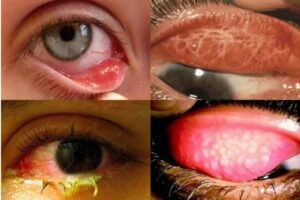bệnh đau mắt hột và cách điều trị