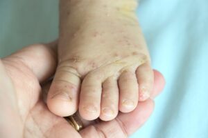 bệnh ghẻ nước ở trẻ em