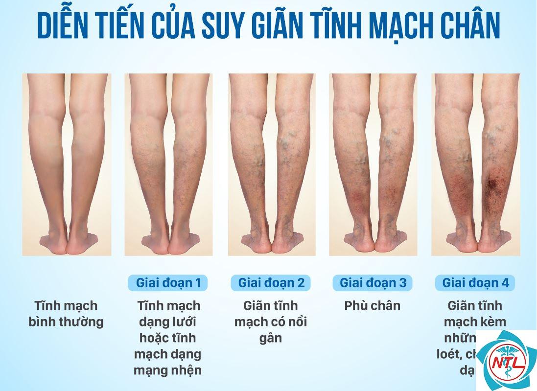 bệnh giãn tĩnh mạch chân có nguy hiểm không - Image 2