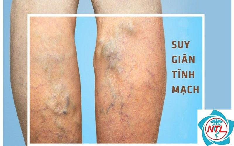 bệnh giãn tĩnh mạch chân có nguy hiểm không - Image 3