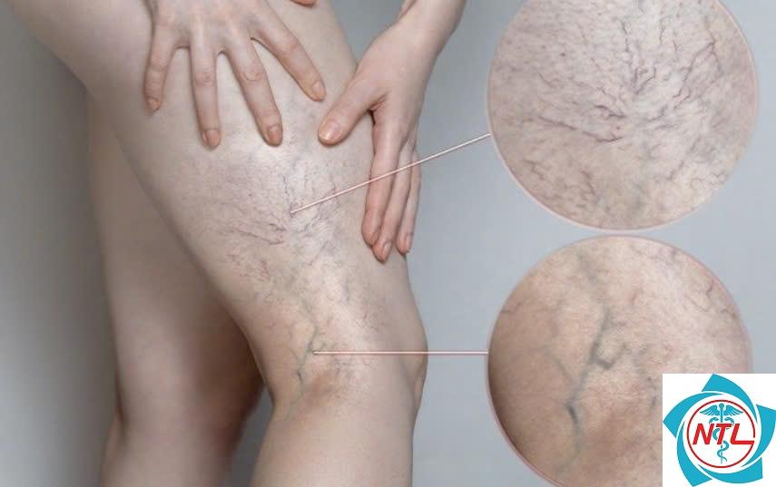 bệnh giãn tĩnh mạch chân có nguy hiểm không - Image 4