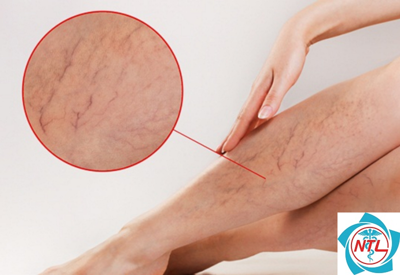 bệnh giãn tĩnh mạch chân có nguy hiểm không - Image 5