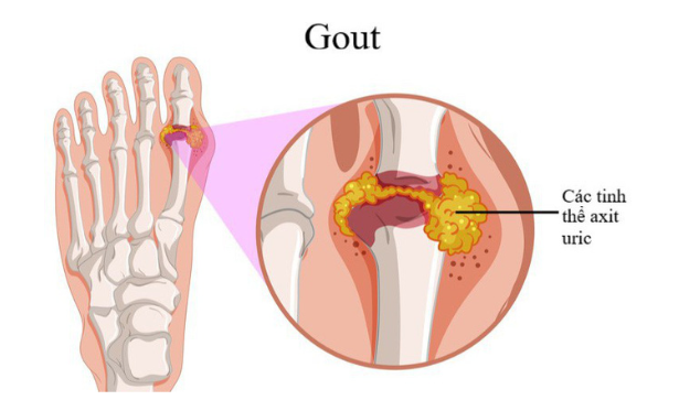 bệnh gout - Image 4