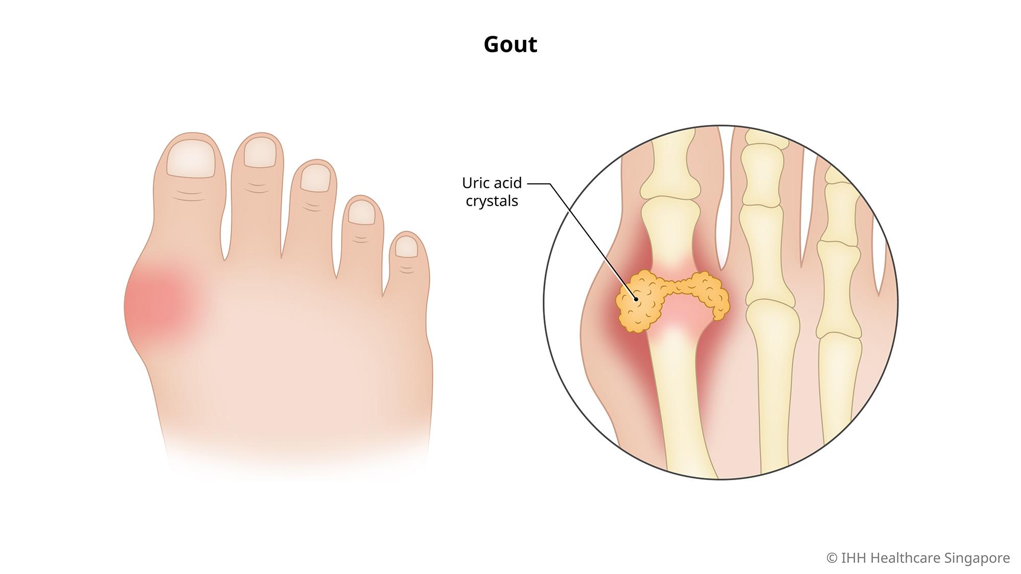 bệnh gout là gì - Image 4