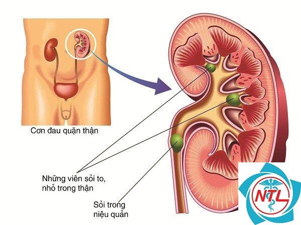bệnh hệ tiết niệu - Image 5