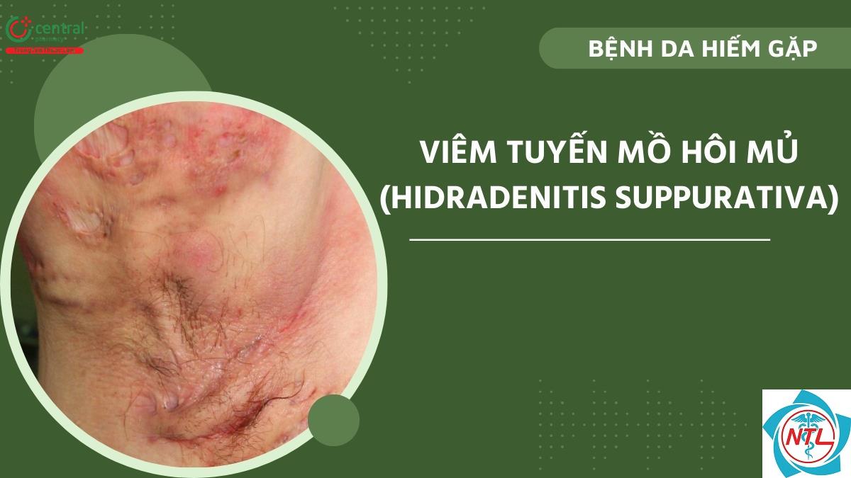 bệnh hidradenitis suppurativa - Image 2