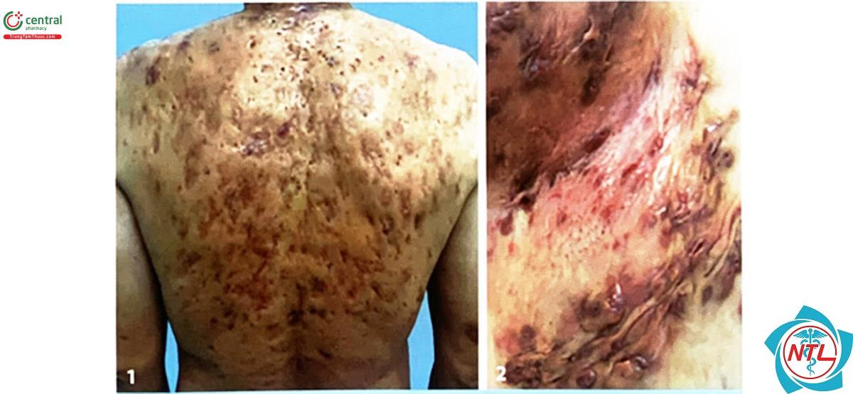 bệnh hidradenitis suppurativa - Image 3