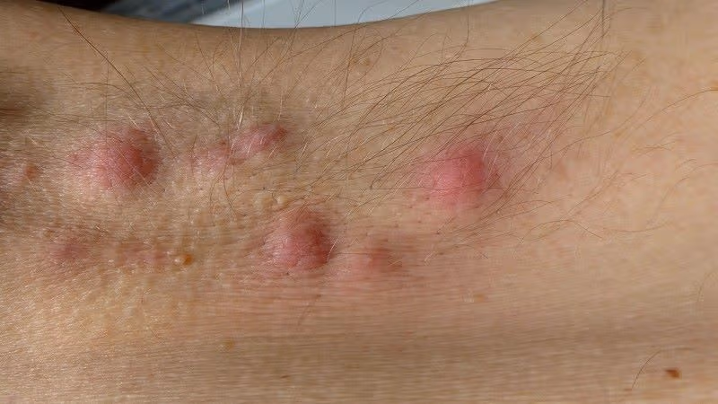 bệnh hidradenitis suppurativa - Image 5
