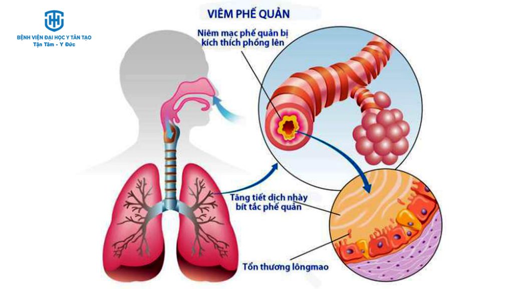 bệnh hô hấp thường gặp - Image 4
