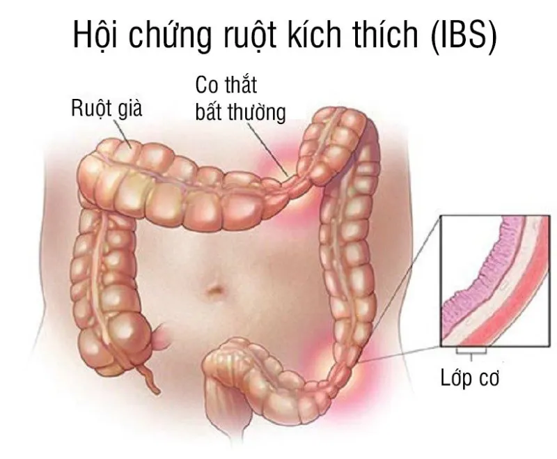 bệnh ibs là gì