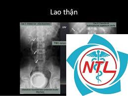 bệnh lao thận - Image 3