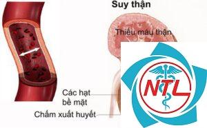 bệnh lao thận