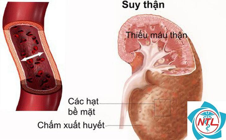 bệnh lao thận