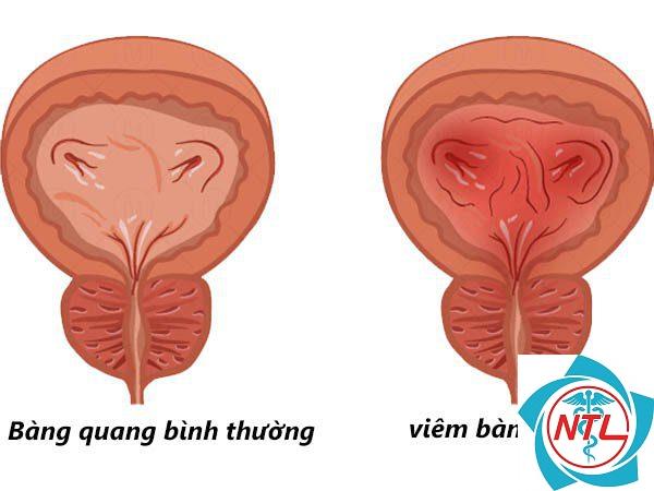 bệnh lý bàng quang - Image 2