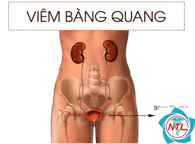 bệnh lý bàng quang - Image 4