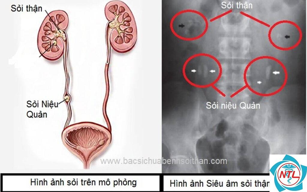 bệnh lý niệu quản