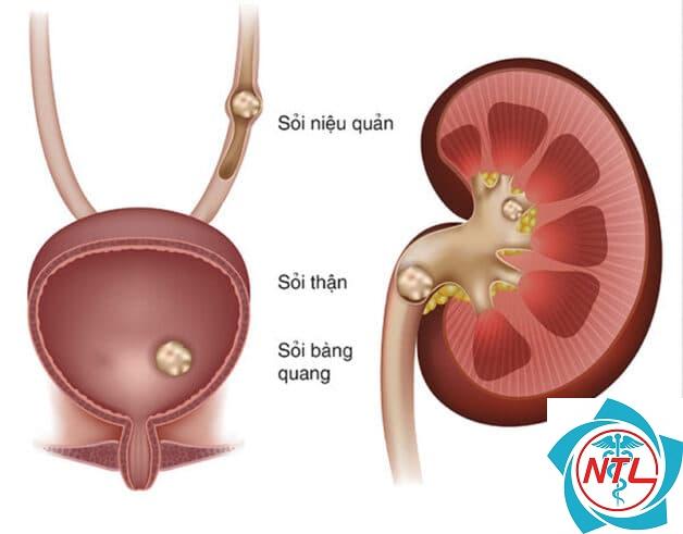 bệnh lý niệu quản - Image 2