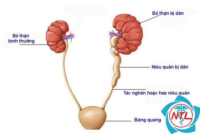 bệnh lý niệu quản - Image 5