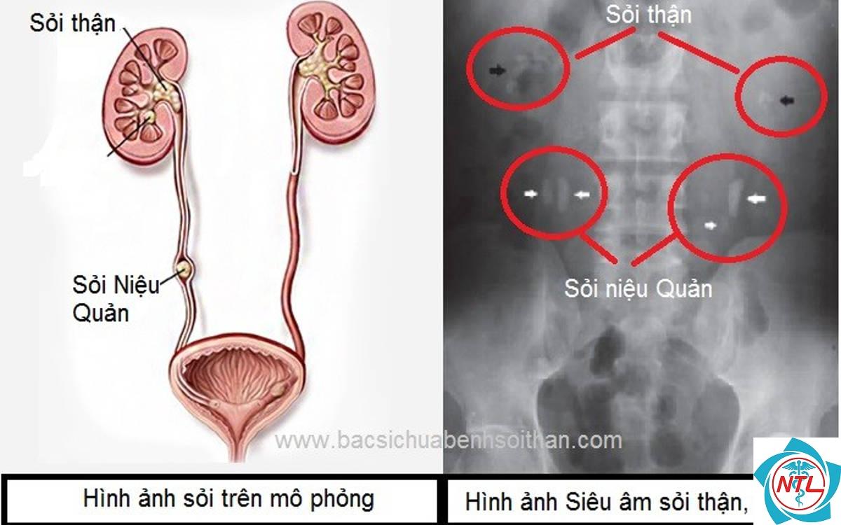 bệnh lý niệu quản - Image 1
