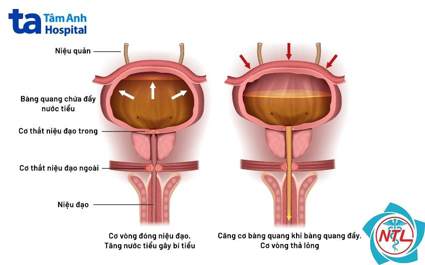 bệnh niệu quản - Image 3