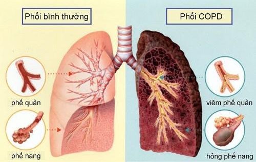 bệnh phổi tắc nghẽn mạn tính - Image 4