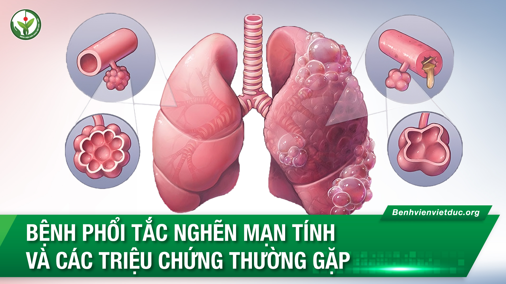 bệnh phổi tắc nghẽn mạn tính - Image 5