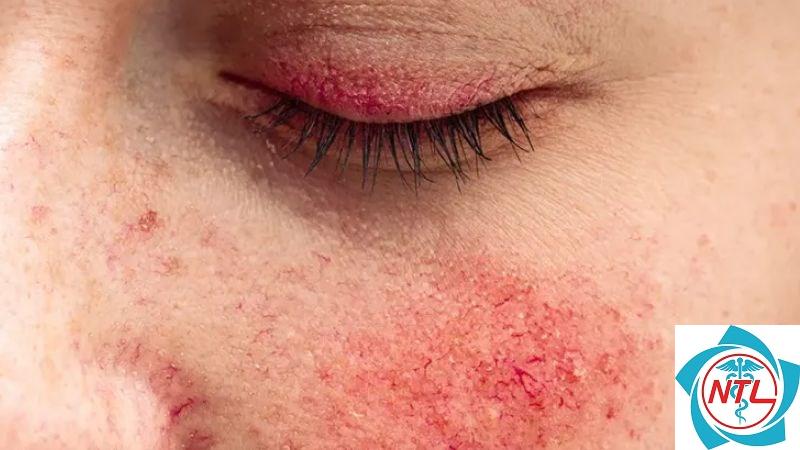 bệnh rosacea - Image 2