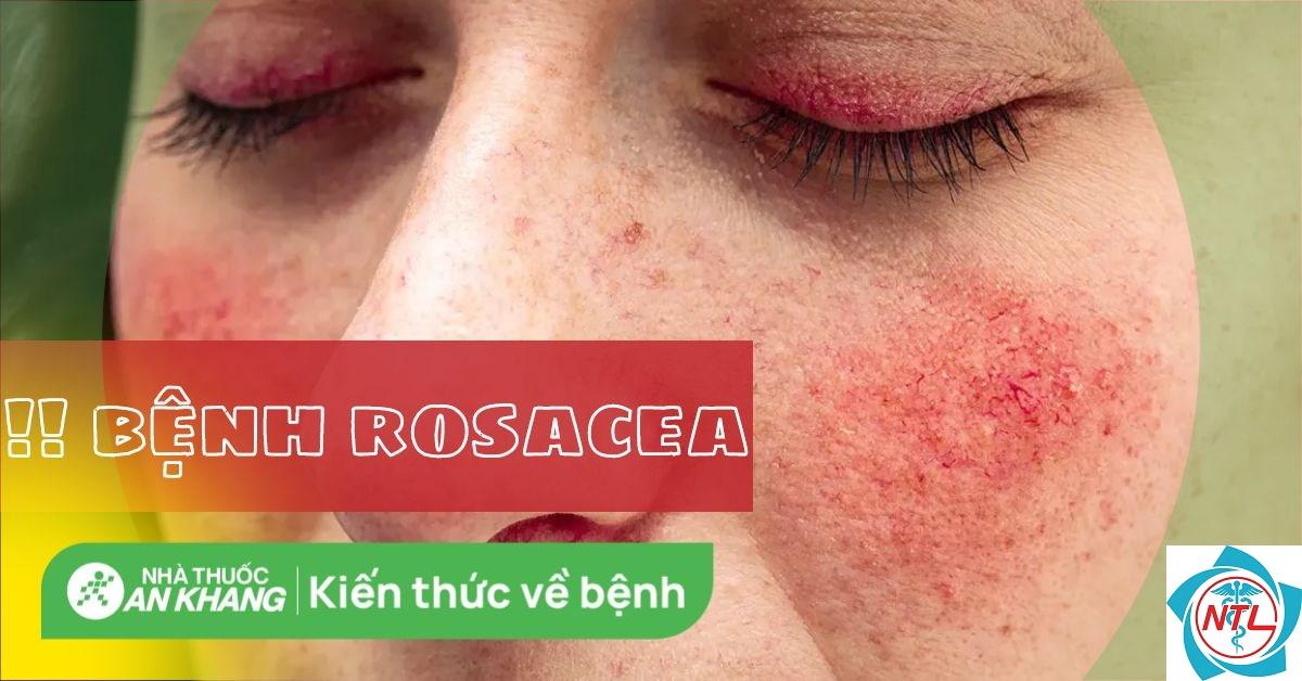bệnh rosacea - Image 5