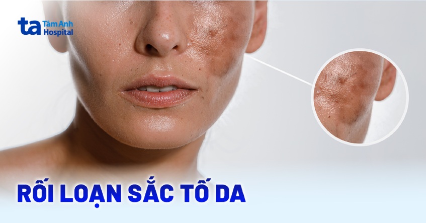 bệnh sắc tố da - Image 2