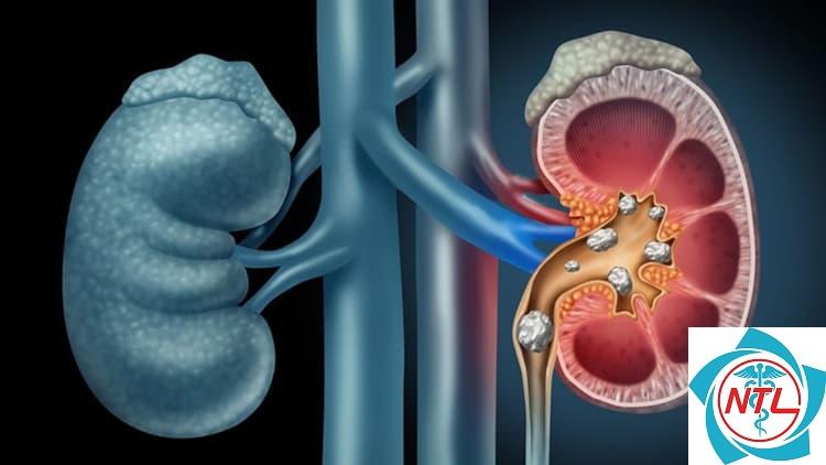bệnh sỏi tiết niệu tái phát - Image 2