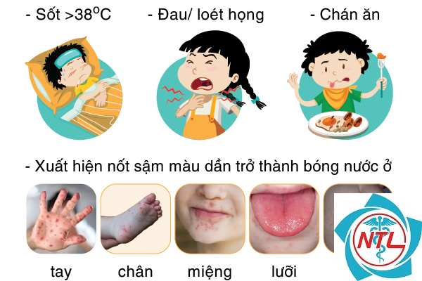 bệnh tay chân miệng - Image 3