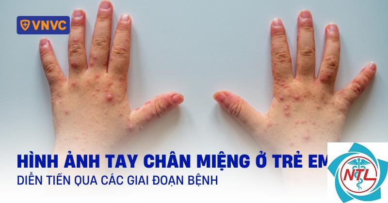 bệnh tay chân miệng - Image 4
