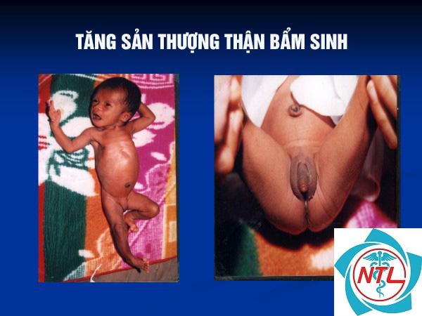 bệnh thận bẩm sinh - Image 3
