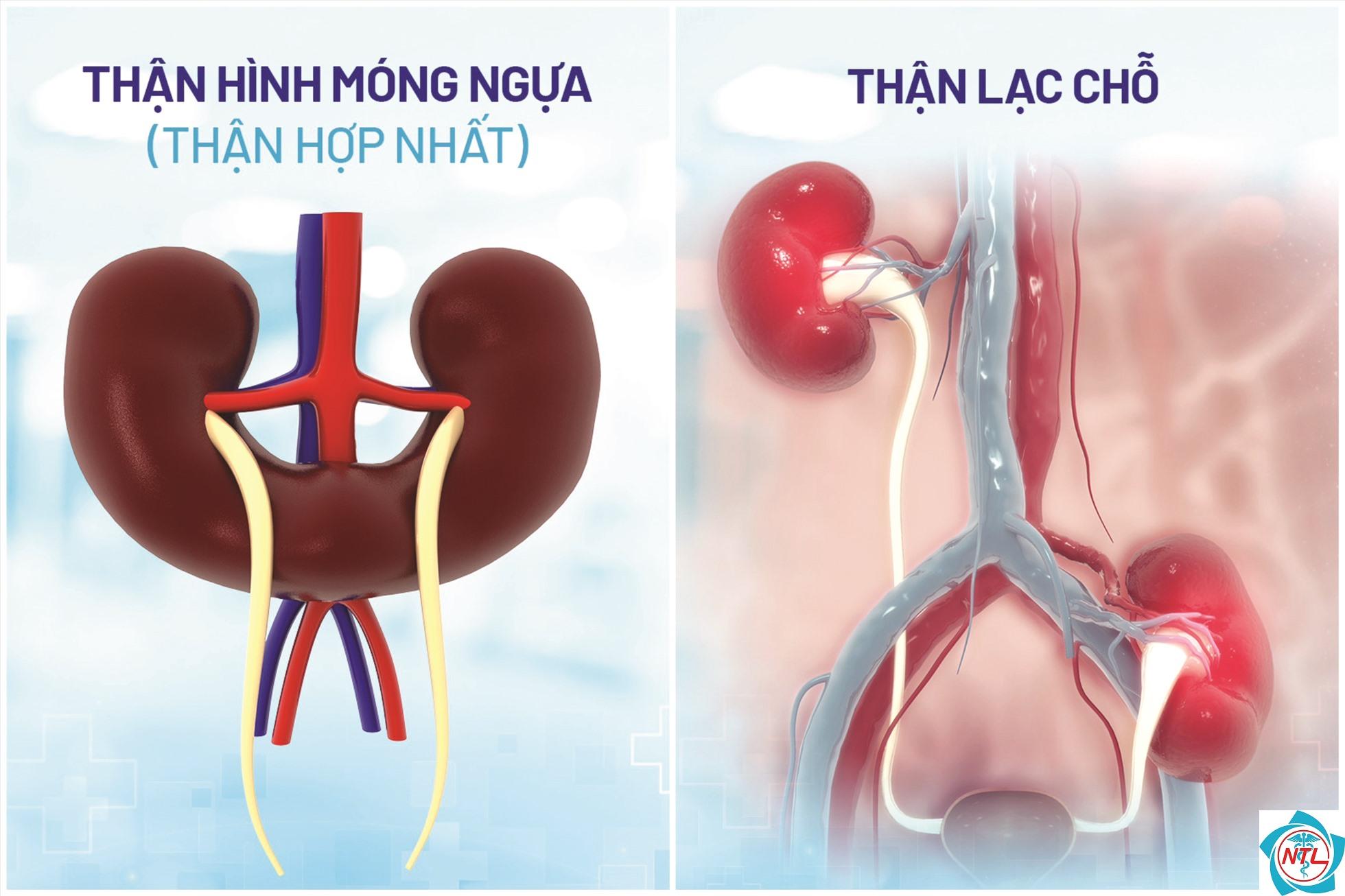 bệnh thận bẩm sinh - Image 5