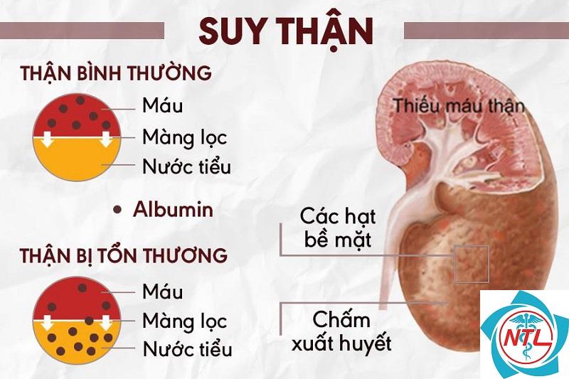 bệnh thận giai đoạn 2 - Image 4