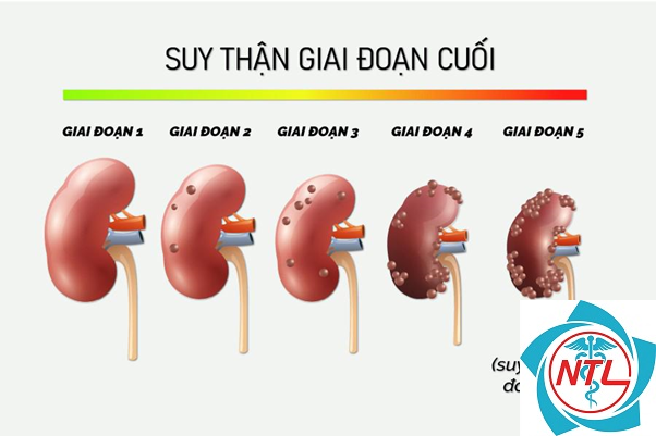 bệnh thận giai đoạn 5 - Image 2