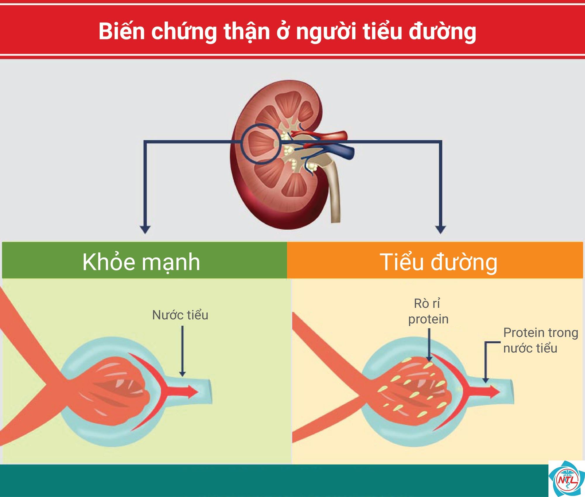 bệnh thận mạn do đái tháo đường - Image 2